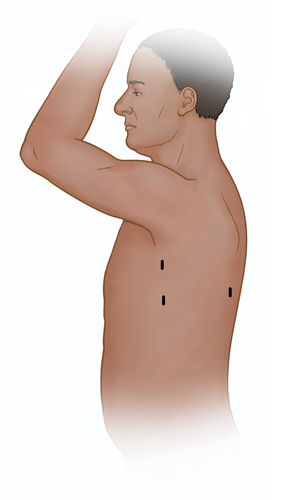 Side view of male torso showing possible incision sites for thoracoscopy.