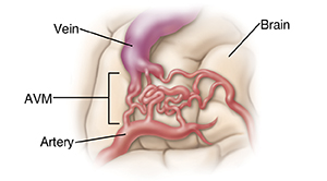 Closeup view of arteriovenous malformation (AVM) in the brain.