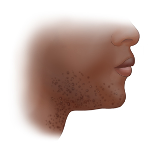 Folliculitis on dark skin.