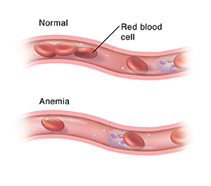 Cross section of blood vessel with normal amounts of red blood cells. Below it is another cross section of blood vessel showing too few red blood cells because of anemia.