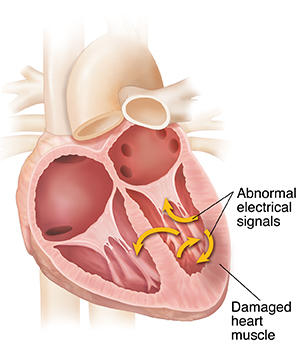 Cross section of heart showing ventricular fibrillation.