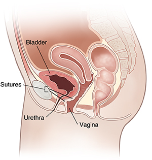 Side view of female pelvic organs showing the bladder, vagina, urethra and skin incision and sutures for retropubic suspension surgery.
