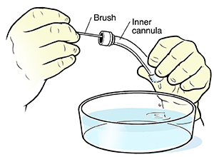 Closeup of hands pushing cleaning brush through tracheostomy tube over a bowl of water.