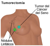 Ilustración de una tumorectomía