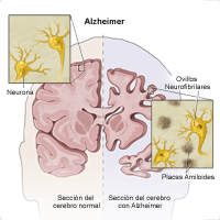 Ilustración que muestra cómo el Alzheimer afecta al cerebro