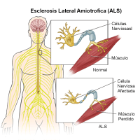 Ilustración de esclerosis lateral amiotrófica