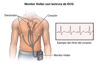 Un torso de hombre con cables pegados al pecho. Los cables están conectados a un monitor Holter atado a la cintura de sus pantalones.