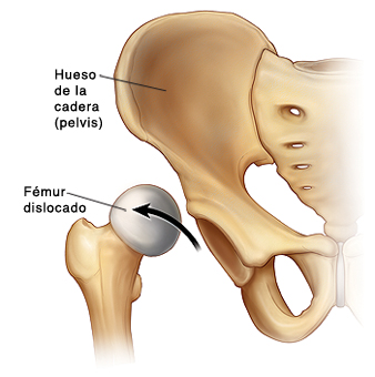 Vista frontal del hueso de la cadera (pelvis) que muestra un fémur dislocado; la cabeza se sale de la cavidad.