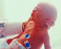 Fotografía de un recién nacido en la unidad de cuidados intensivos neonatales