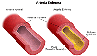 Ilustración de una arteria normal y una enferma