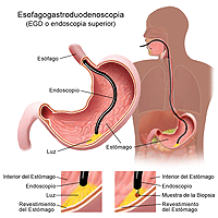 Ilustración de un procedimiento de eofagogastroduodenoscopia