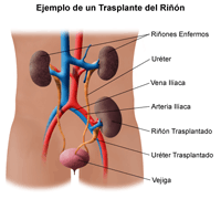 Ejemplo de un trasplante de riñón