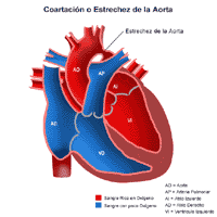 Anatomía de un corazón con conducto con coartación de la aorta