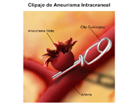 Ilustración de un clipaje de aneurisma intracraneal