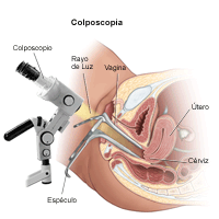 Ilustración del procedimiento de colposcopia