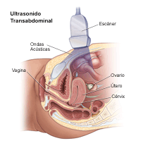 Ilustración del procedimiento de ultrasonido transabdominal