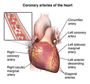 Imagen que muestra la parte exterior del corazón y las arterias coronarias