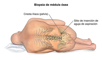 Vista de una zona de la biopsia ósea de la pelvis