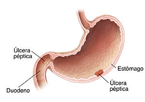 Corte transversal de estómago y duodeno. Se ven llagas en el recubrimiento del estómago y en el duodeno que son úlceras pépticas.