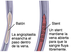 Corte transversal de una vena con un catéter con balón. Corte transversal de una vena con un stent donde puede verse el flujo sanguíneo a través del stent.