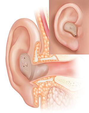 Corte transversal del oído donde se observa un audífono colocado en el conducto auditivo externo y un recuadro en el que se muestra la vista externa.