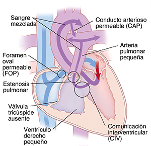 Vista de las cuatro cavidades del corazón donde se observa la atresia tricúspide. Las flechas indican que la sangre no puede fluir desde la aurícula derecha hacia el ventrículo derecho.