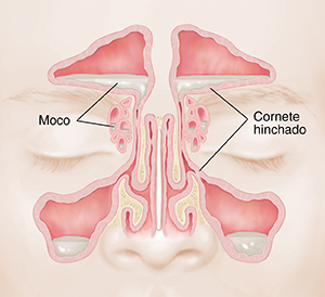Vista frontal de una cara en la que se muestran los senos paranasales. El recubrimiento del seno está pálido e hinchado, y se está acumulando líquido en el interior.