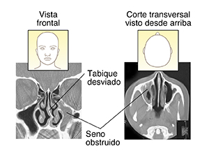Tomografía computarizada de tabique desviado y senos paranasales bloqueados (vista frontal). Tomografía computarizada de senos paranasales bloqueados (corte transversal visto desde arriba).