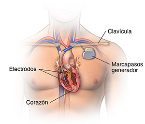 Front view of male chest showing pacemaker.