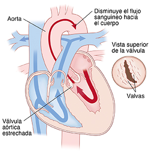 Vista de las cuatro cavidades del corazón, donde se observa la válvula aórtica bicúspide. Las flechas indican que fluye menos sangre a través de la válvula aórtica. En el recuadro, se muestra una vista superior de la válvula bicúspide.