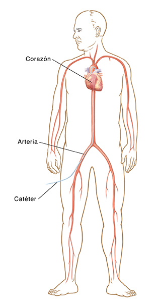 Cuerpo de hombre con un catéter insertado en la pierna que va hasta una arteria del corazón. 