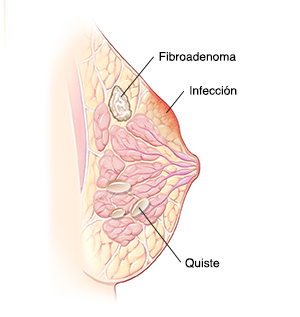Corte transversal de la vista lateral de un seno en donde se ven un fibroadenoma, infección y quistes.