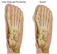 Ilustración de un dedo gordo normal y de un dedo gordo con juanete