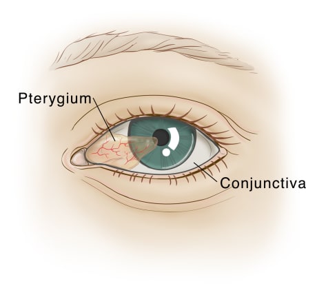 Front view of eye with clear tissue growing over white of eye and onto pupil.