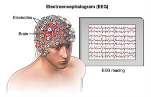 Side view of head showing brain with abnormal electrical impulses. 