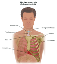 Ilustración de un procedimiento de mediastinoscopia