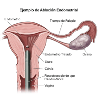 Ilustración del procedimiento de ablación endometrial