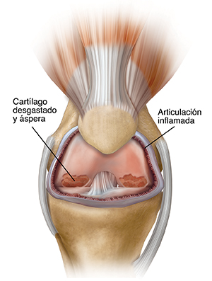 Vista frontal de una rodilla con artritis.