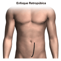 Ilustración de un enfoque retropúbico de prostatectomía