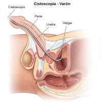 Ilustración de la cistoscopia